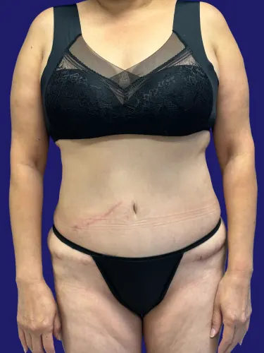 Tummy Tuck Case #2632758 — after, Dr. Frank Albino