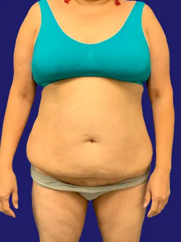 Tummy Tuck Case #2632758 — before, Dr. Frank Albino