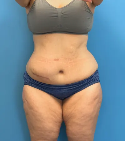 Tummy Tuck Case #28426 — before, Dr. Samir Rao