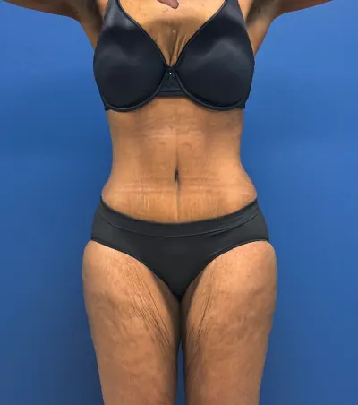 Tummy Tuck Case #28714 — after, Dr. Samir Rao