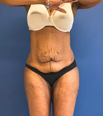 Tummy Tuck Case #28714 — before, Dr. Samir Rao