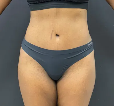Tummy Tuck Case #340 — after, Dr. Arjun Kanuri
