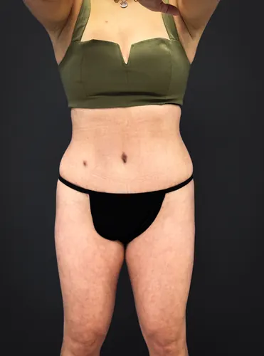 Tummy Tuck Case #3757 — after, Dr. Samir Rao