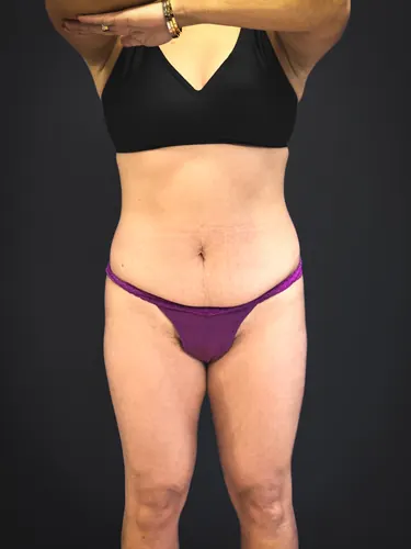 Tummy Tuck Case #3757 — before, Dr. Samir Rao