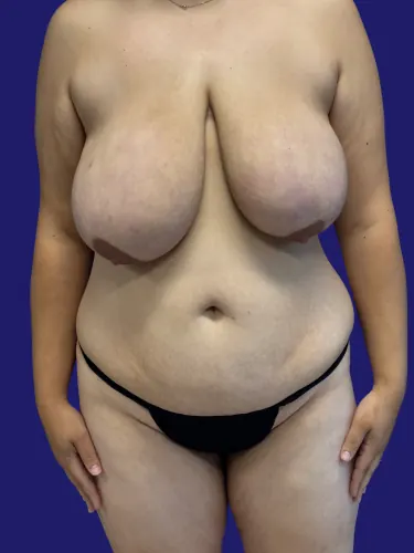 Tummy Tuck Case #6334181 — before, Dr. Frank Albino