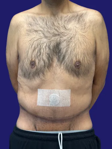 Tummy Tuck Case #6823872 — after, Dr. Frank Albino