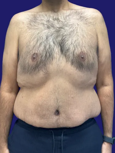 Tummy Tuck Case #6823872 — before, Dr. Frank Albino