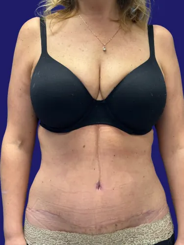 Tummy Tuck Case #6986510 — after, Dr. Frank Albino