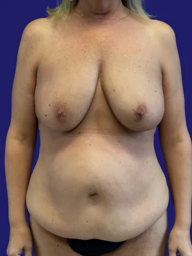 Tummy Tuck Case #6986510 — before, Dr. Frank Albino