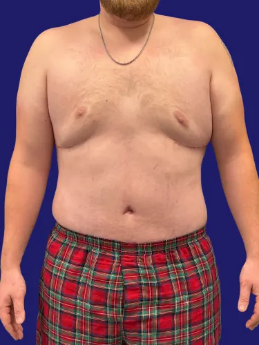 Tummy Tuck Case #8002833 — after, Dr. Frank Albino