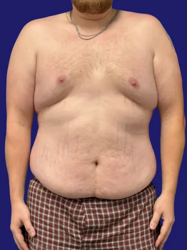 Tummy Tuck Case #8002833 — before, Dr. Frank Albino