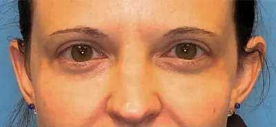 Eyelid Surgery Case #14261 — after, Dr. Samir Rao