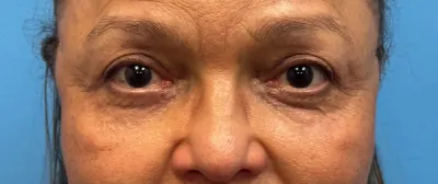 Eyelid Surgery Case #27682 — after, Dr. Samir Rao