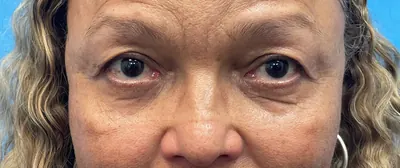 Eyelid Surgery Case #27682 — before, Dr. Samir Rao