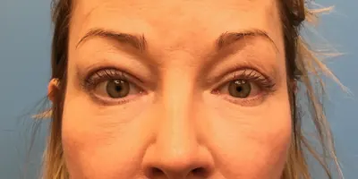 Eyelid Surgery Case #393 — after, Dr. Samir Rao