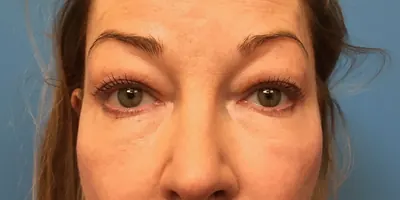 Eyelid Surgery Case #393 — before, Dr. Samir Rao