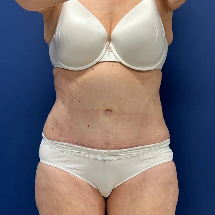After tummy tuck, front view, patient of Dr. Samir Rao