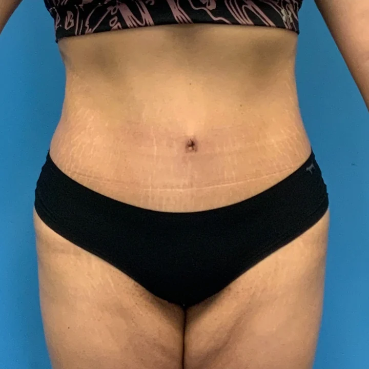 After tummy tuck, front view, patient of Dr. Arjun Kanuri