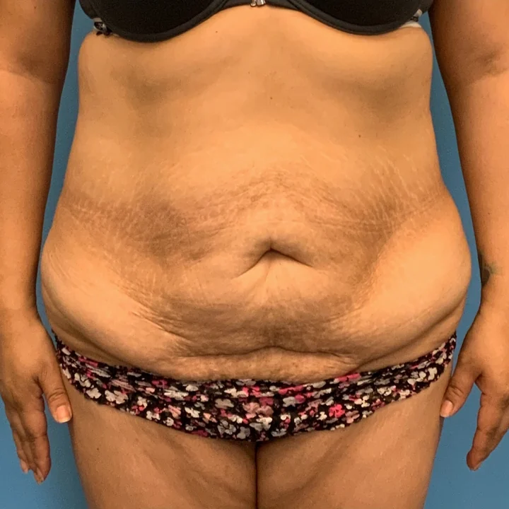 Before tummy tuck, front view, patient of Dr. Arjun Kanuri