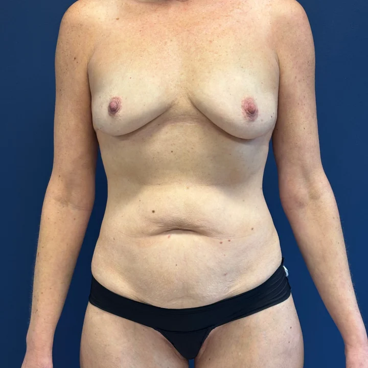 Before tummy tuck, front view, patient of Dr. Frank Albino