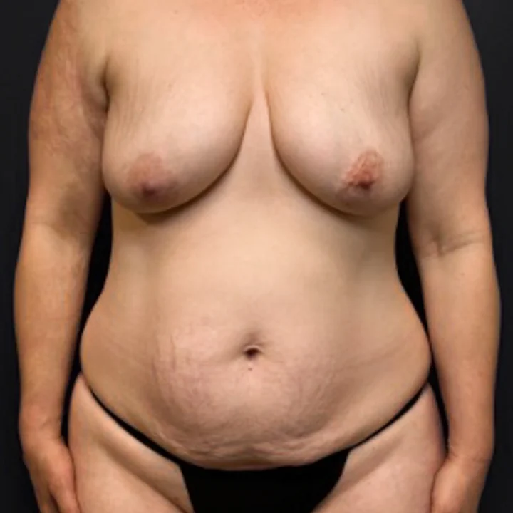 Before tummy tuck, front view, patient of Dr. Arjun Kanuri