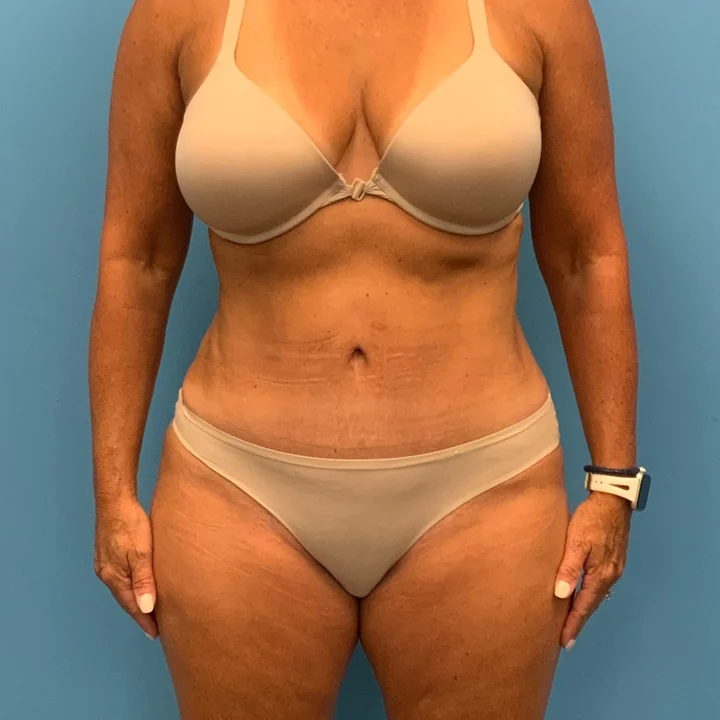 After tummy tuck, front view, patient of Dr. Frank Albino