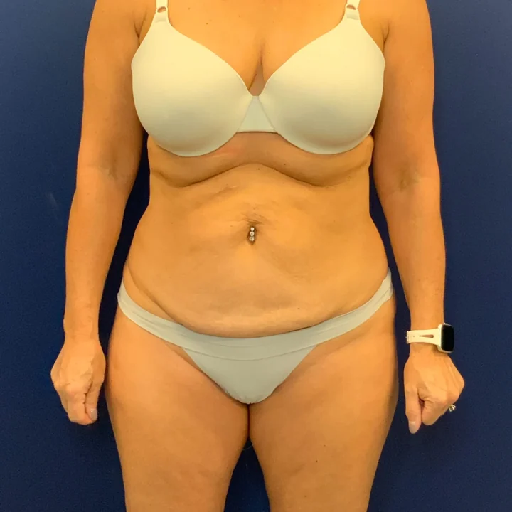 Before tummy tuck, front view, patient of Dr. Frank Albino
