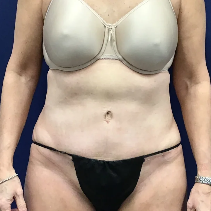 After tummy tuck, front view, patient of Dr. Frank Albino