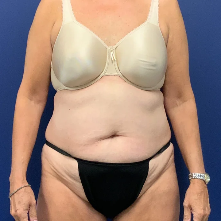 Before tummy tuck, front view, patient of Dr. Frank Albino