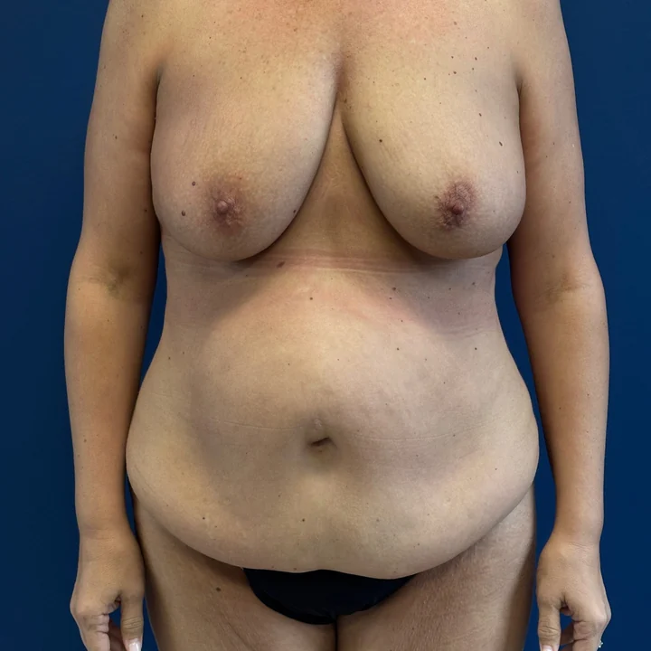 Before tummy tuck, front view, patient of Dr. Frank Albino