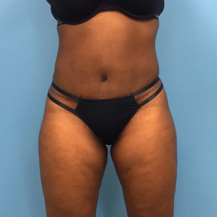 After tummy tuck, front view, patient of Dr. Samir Rao