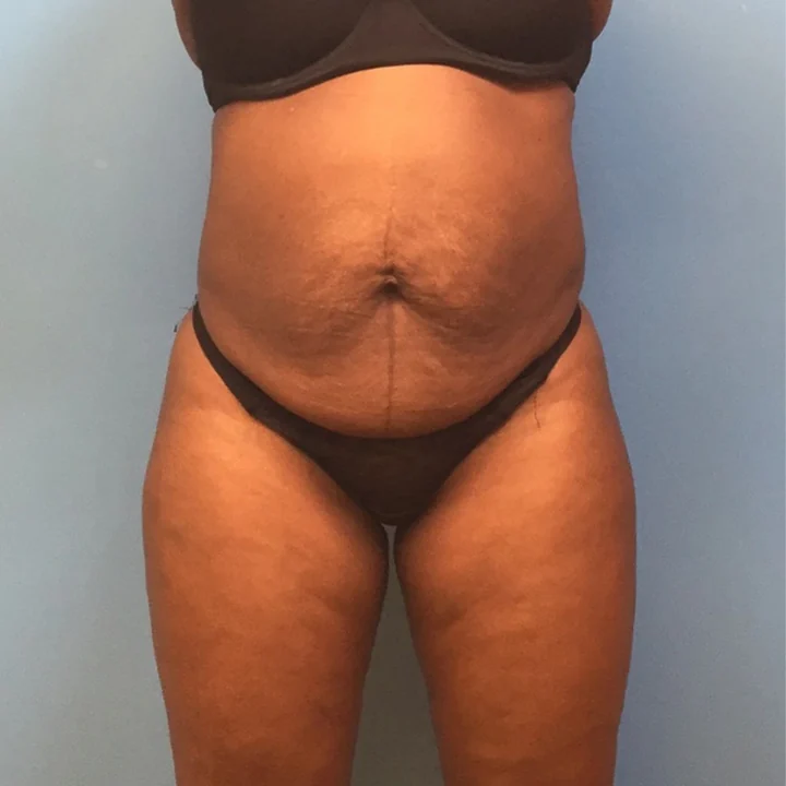 Before tummy tuck, front view, patient of Dr. Samir Rao