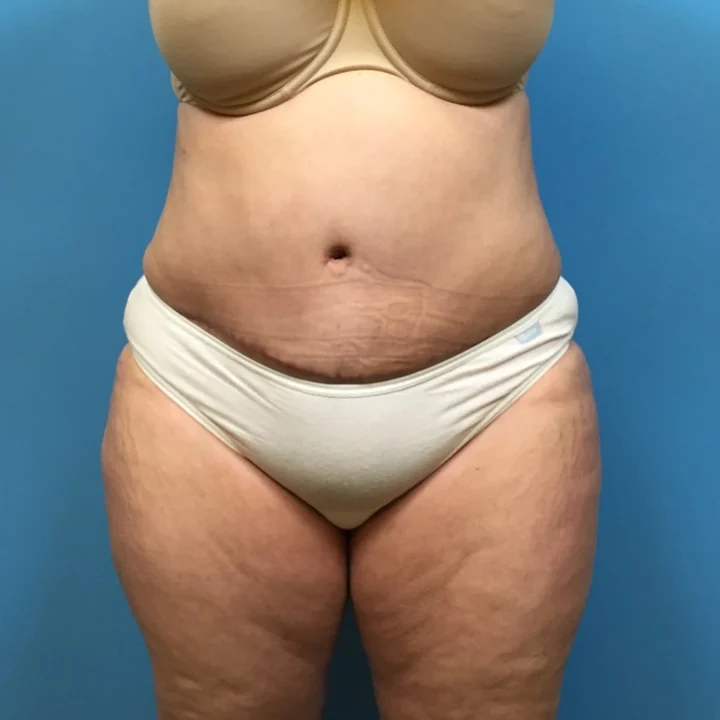 After tummy tuck, front view, patient of Dr. Samir Rao