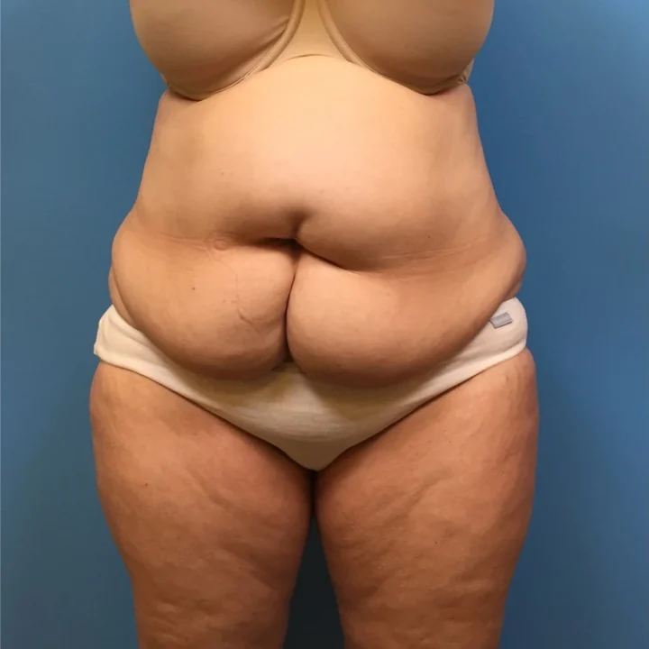 Before tummy tuck, front view, patient of Dr. Samir Rao