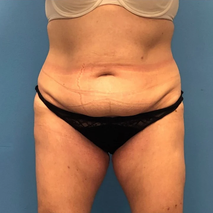 Before tummy tuck, front view, patient of Dr. Samir Rao