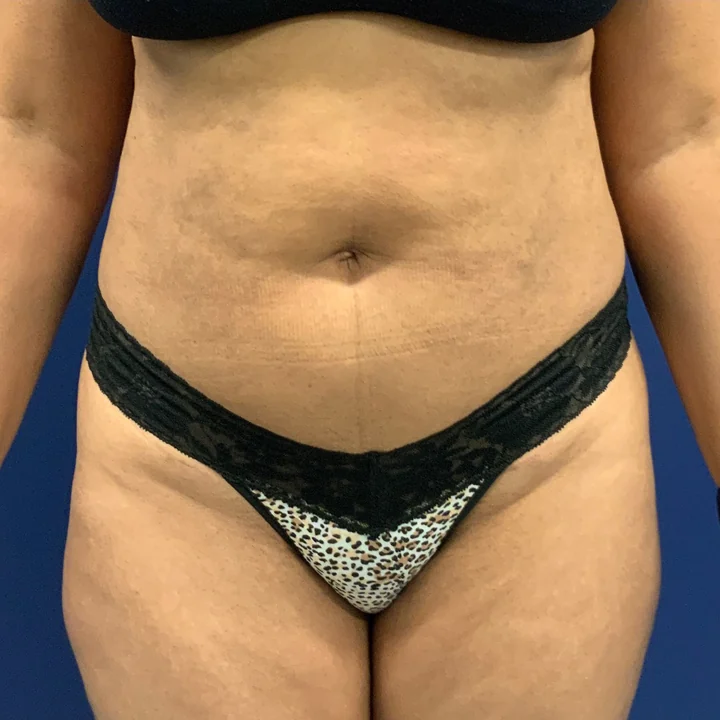 Before tummy tuck, front view, patient of Dr. Frank Albino