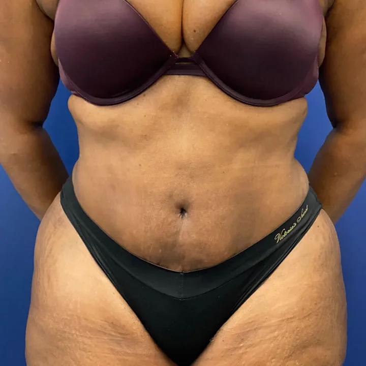 After tummy tuck, front view, patient of Dr. Arjun Kanuri