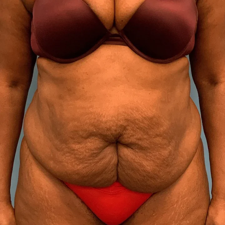Before tummy tuck, front view, patient of Dr. Arjun Kanuri