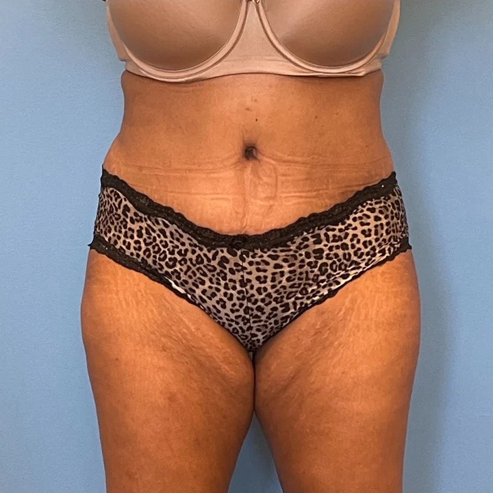 After tummy tuck, front view, patient of Dr. Samir Rao