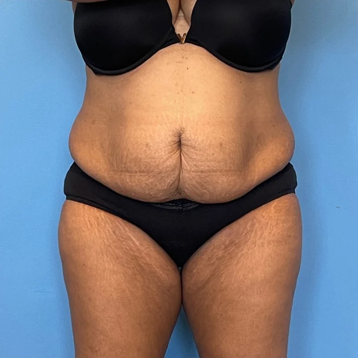 Before tummy tuck, front view, patient of Dr. Samir Rao