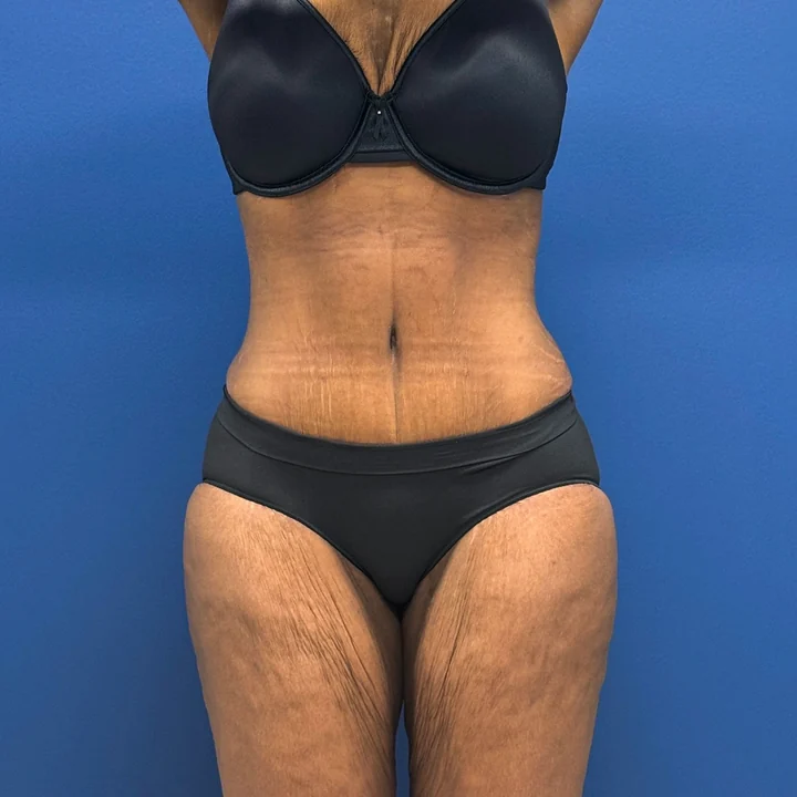After tummy tuck, front view, patient of Dr. Samir Rao