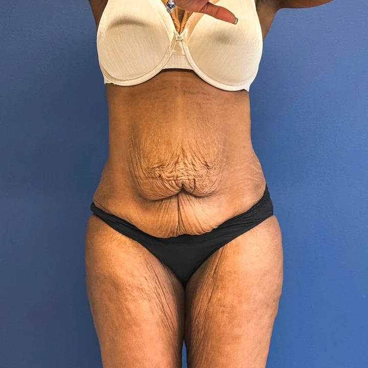 Before tummy tuck, front view, patient of Dr. Samir Rao