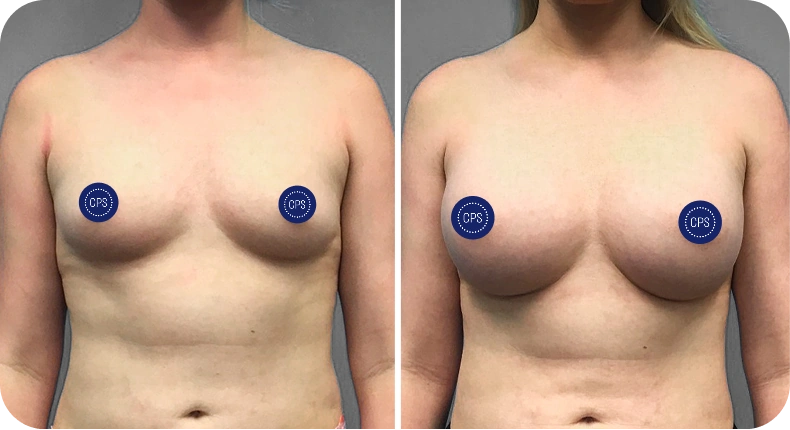 Before and after breast augmentation comparison with privacy protection markers