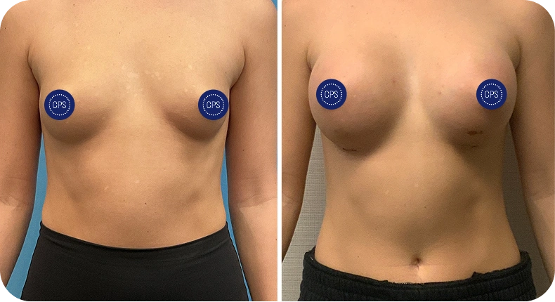 Before and after breast augmentation comparison with privacy protection markers