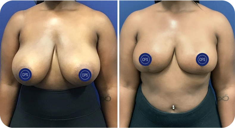 Before and after breast lift and reduction demonstrating lifted contour and reduced volume