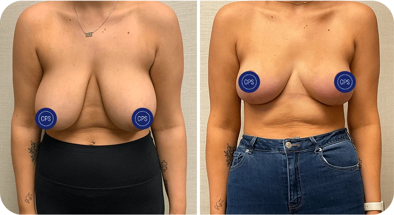 Before and after breast lift and reduction with improved projection and reduced sagging