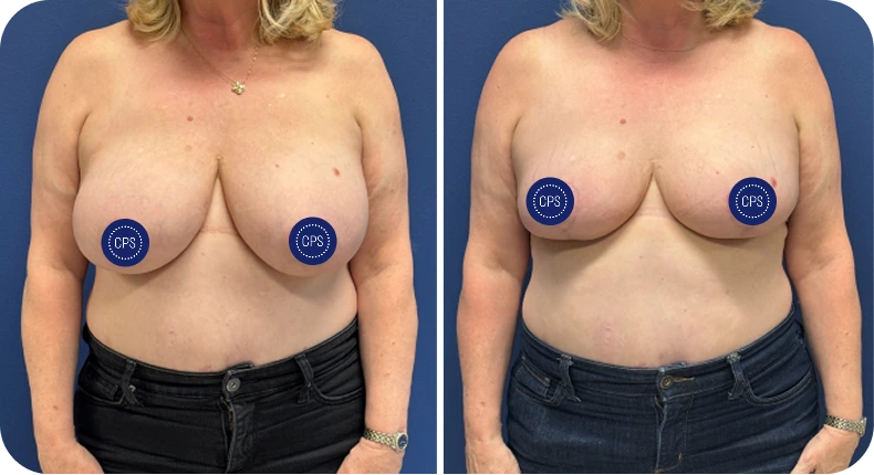 Before and after breast lift and reduction results showing improved shape and positioning