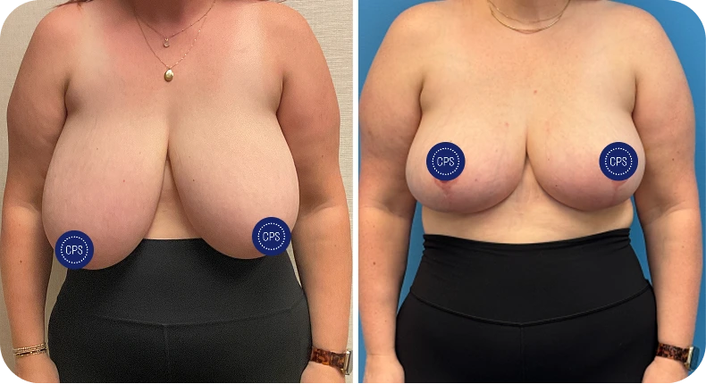 Before and after breast lift and reduction showing elevated position and refined shape