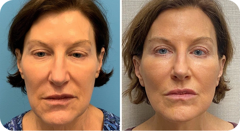 Before and after facelift comparison showing woman's face from front with lifted jawline and reduced sagging