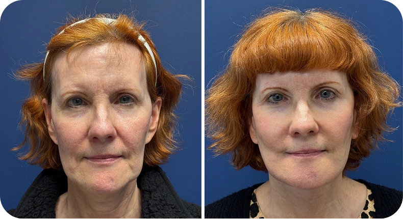 Before and after facelift results showing woman's face from front, with improved facial contours and skin tightness
